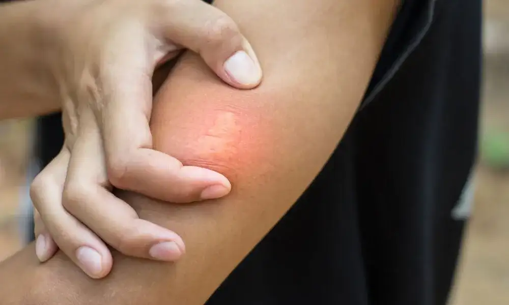 Użądlenie osy: kiedy do lekarza, aby uniknąć poważnych komplikacji