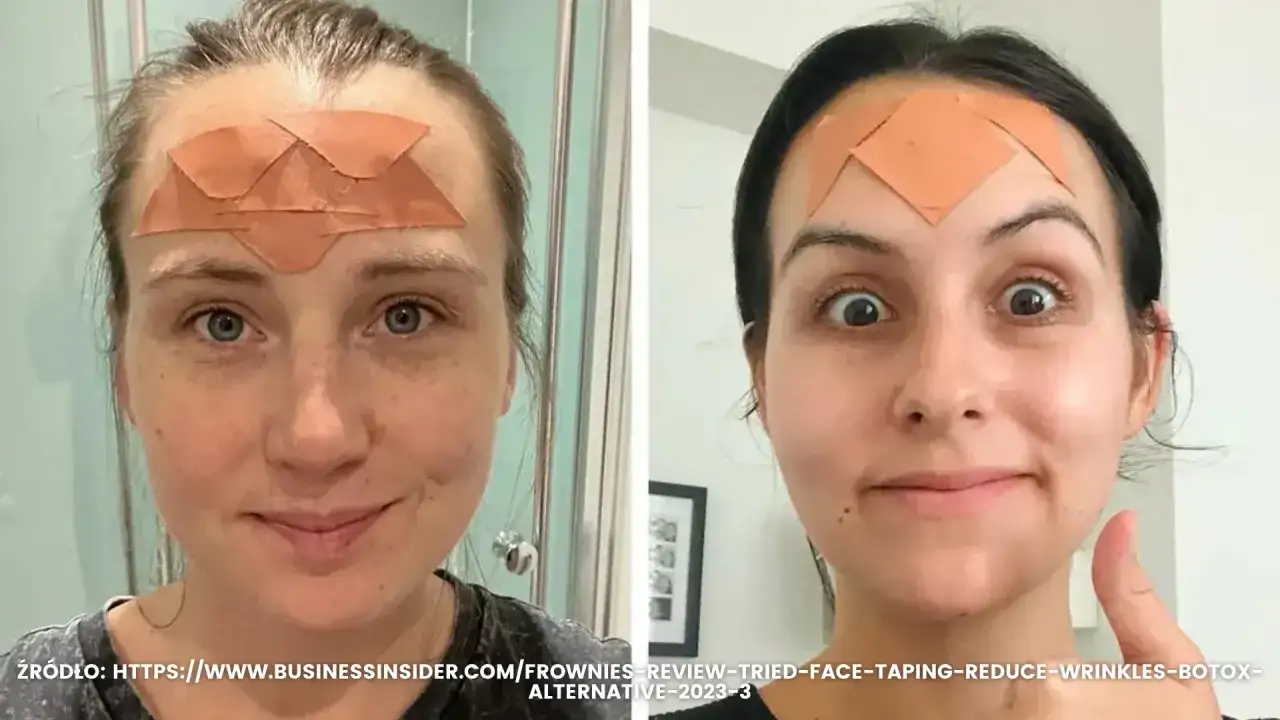 Lwia zmarszczka: Botoks czy kwas hialuronowy? Wybierz mądrze!