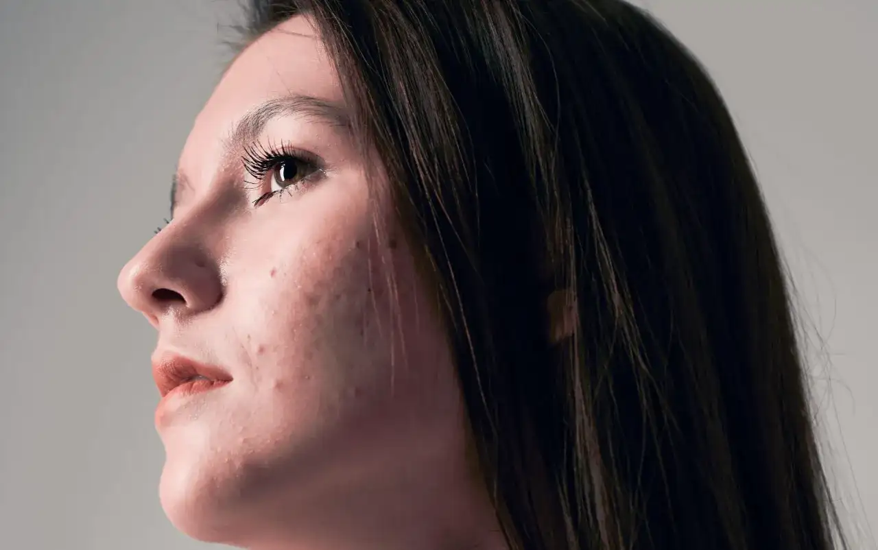 Bielenda Acid Fusion 3.0: Skuteczny krem na trądzik i przebarwienia