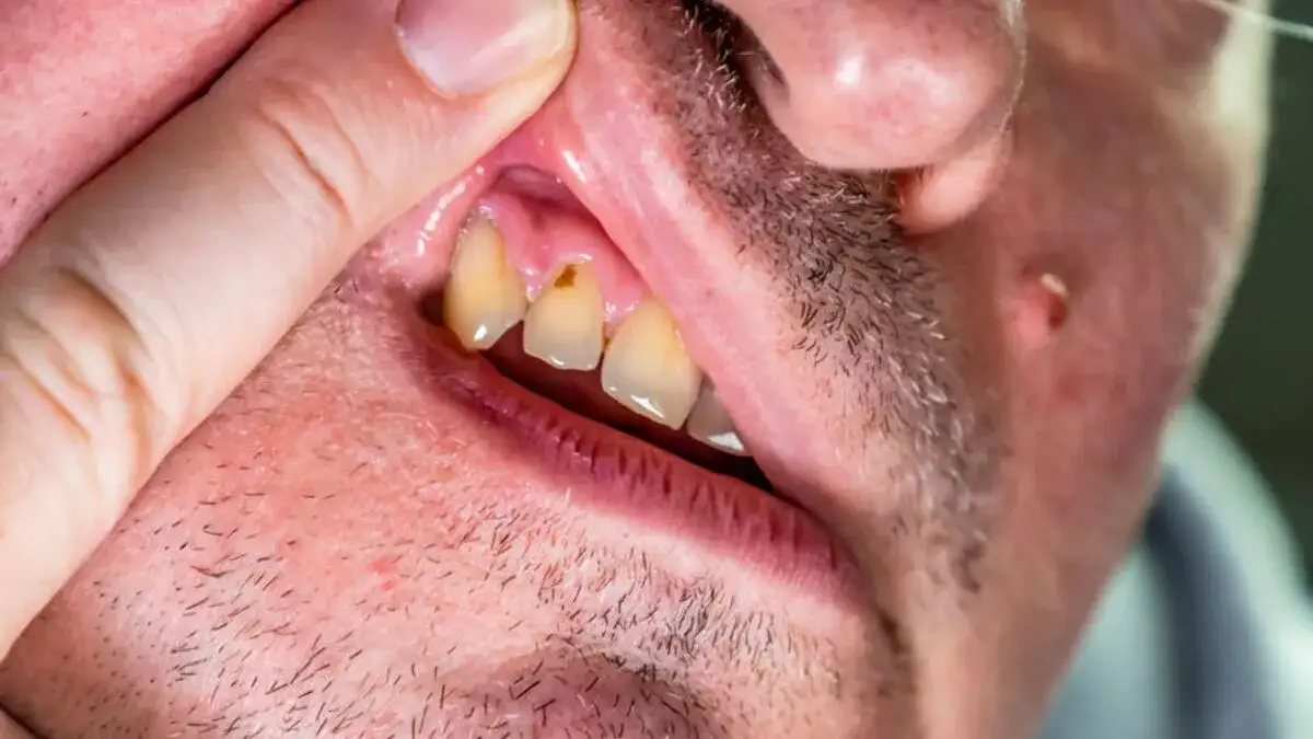 Ropa przy zębie: Jak leczyć ropień? Objawy, powikłania, dentysta.