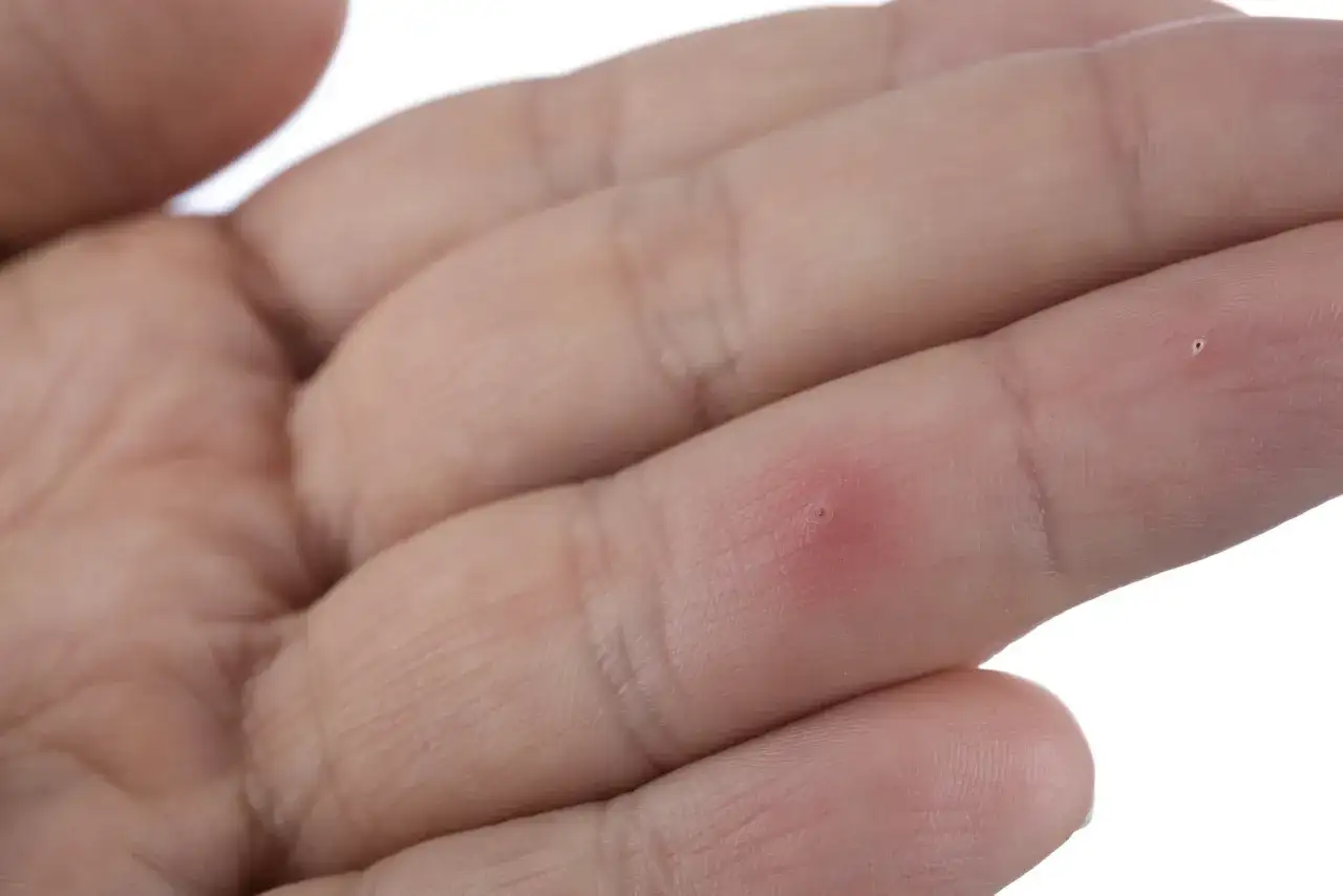 Jak lekarz usuwa drzazgę spod paznokcia: procedura krok po kroku