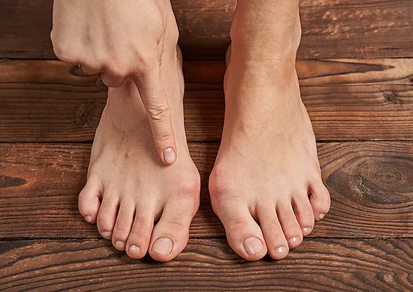 Paluch koślawy: Co to jest i jak skutecznie leczyć haluksy?