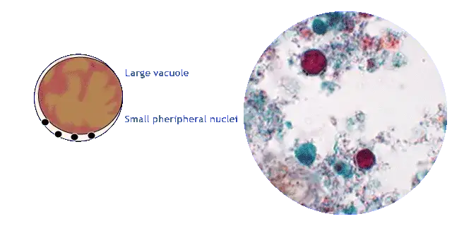 Blastocystis hominis: Jak rozpoznać i skutecznie leczyć?