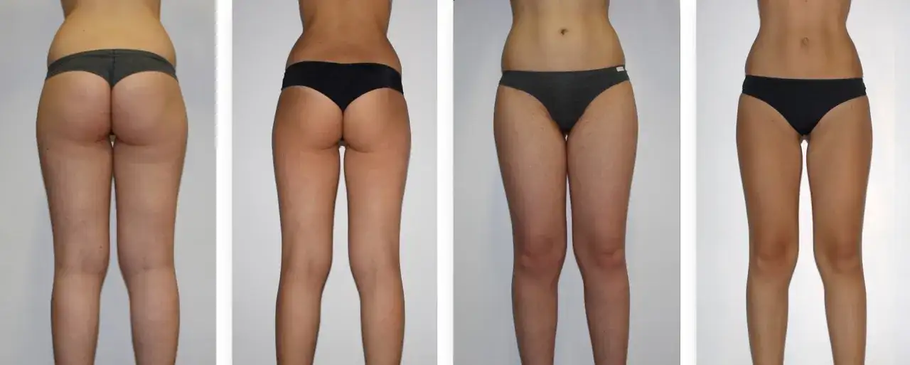 Endermologia: Czy warto? Analiza kosztów, efektów i opinii eksperta