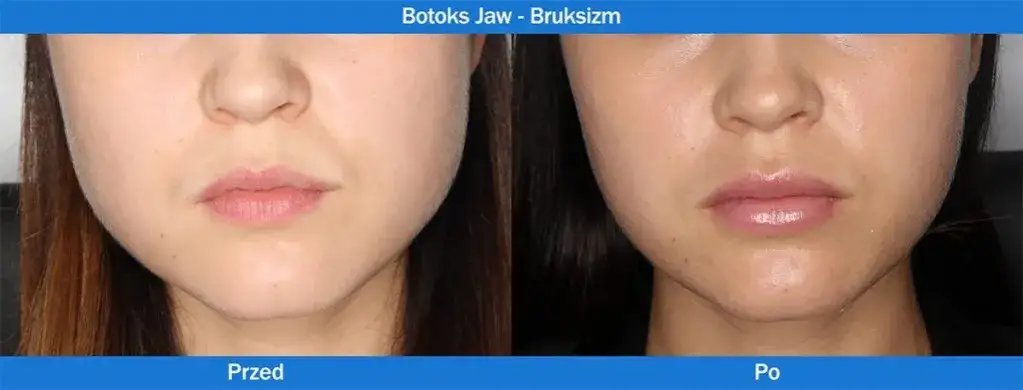 Ile kosztuje botoks? Poznaj ceny i czynniki wpływające na koszt