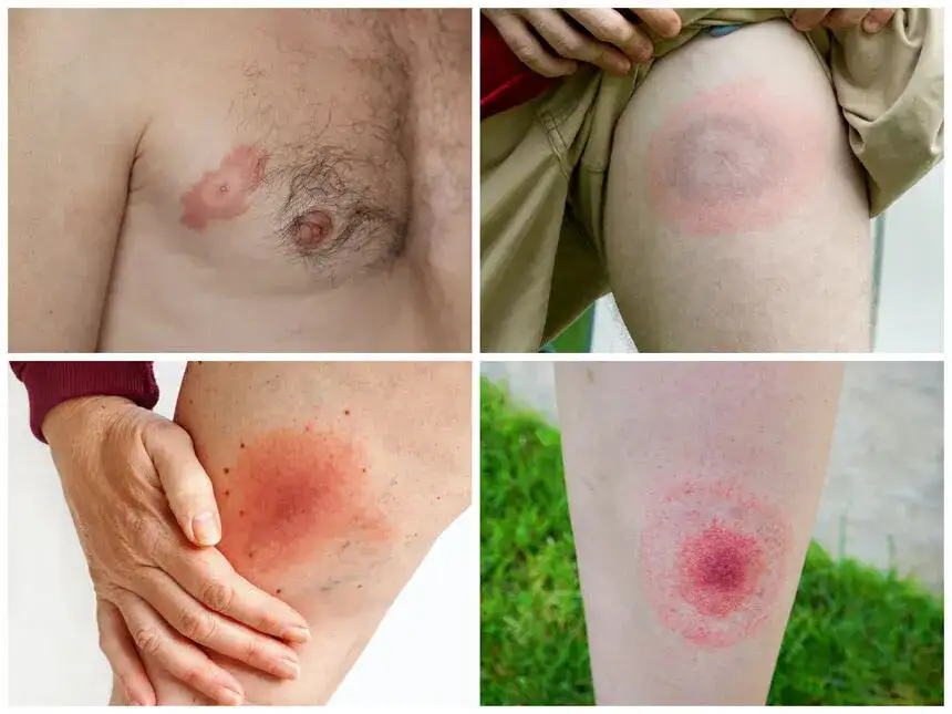 Jakie są objawy boreliozy - rozpoznaj groźną chorobę z Lyme wcześnie