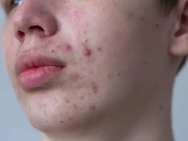 Od czego są pryszcze na brodzie? Odkryj nieznane przyczyny i rozwiązania