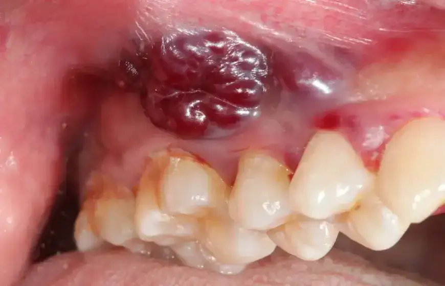 Rak płaskonabłonkowy jamy ustnej: objawy rozpoznaj i uratuj życie!