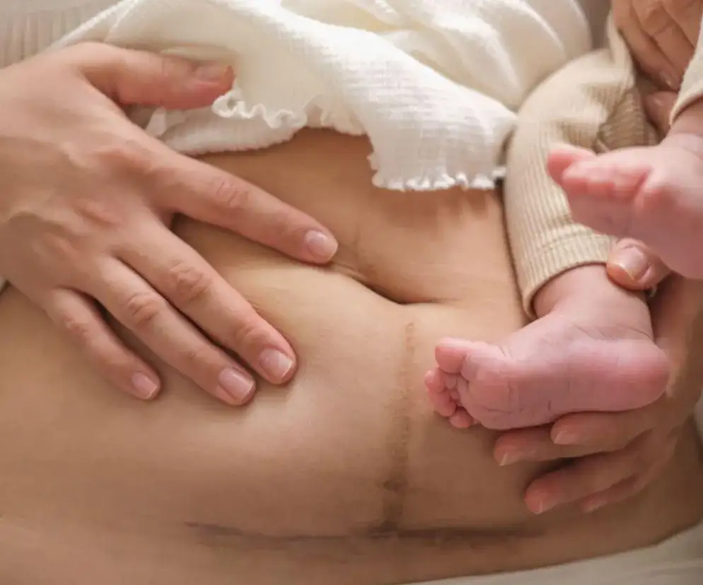 Ból brzucha po cesarce: Co jest normą, a co sygnałem alarmowym?