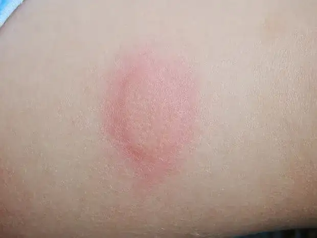 Bolesne gule pod skórą: Szybkie sposoby leczenia i zapobiegania