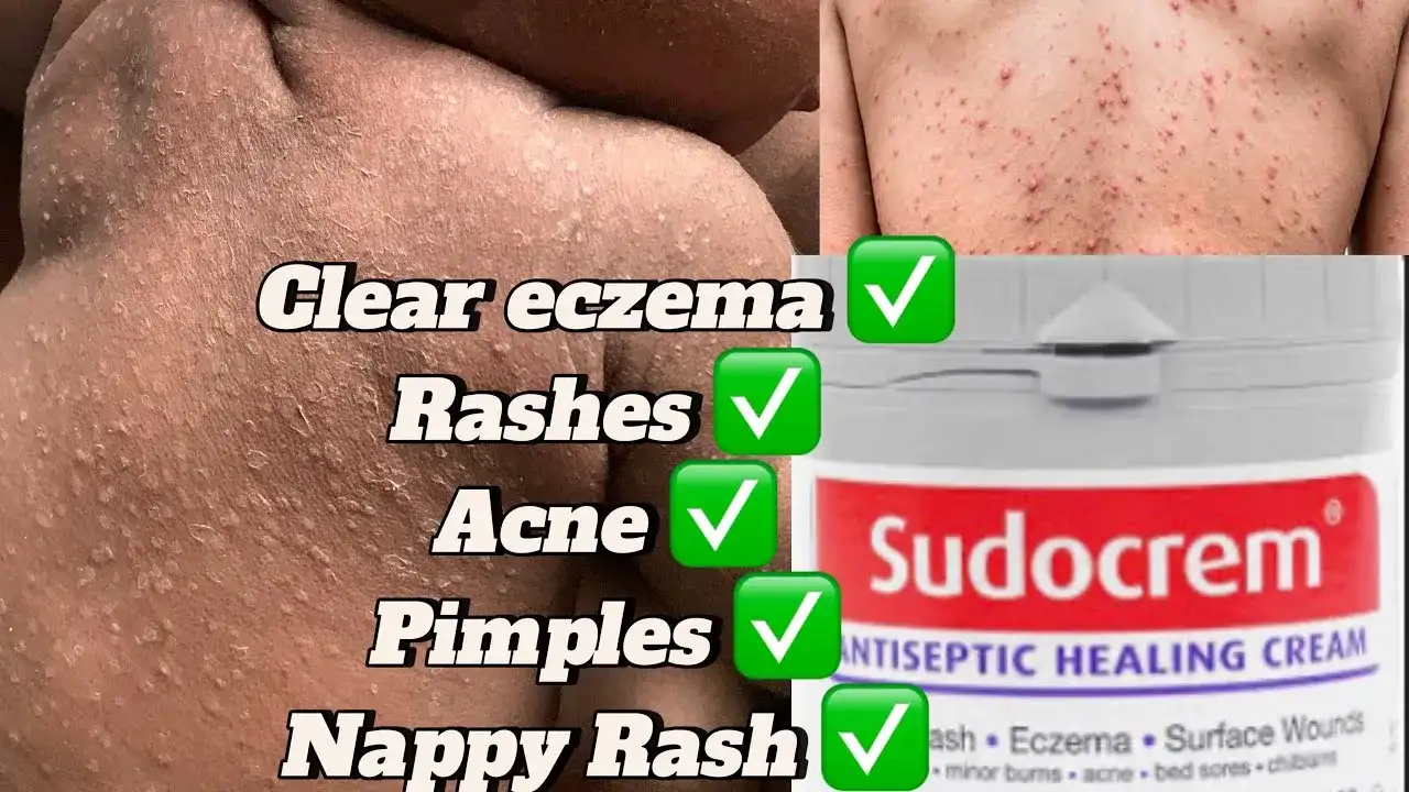 Sudocrem na pryszcze: Czy krem dla dzieci ratuje cerę trądzikową?