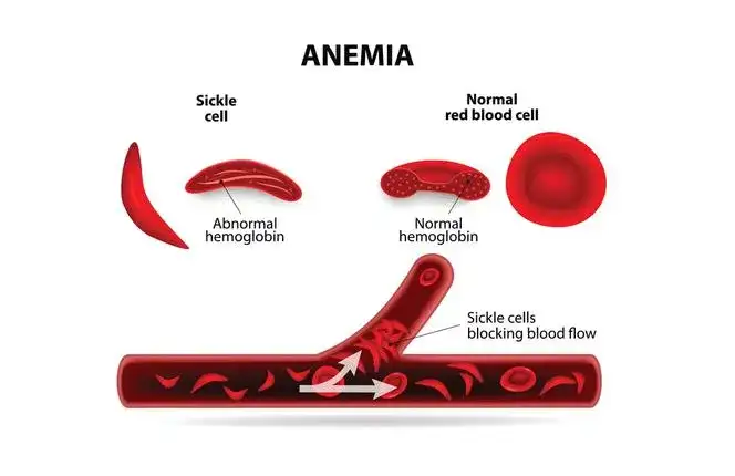 Co naprawdę powoduje anemię? Najważniejsze przyczyny i objawy.