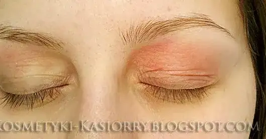 Alergia na oprawki okularowe: objawy, przyczyny i jak sobie radzić