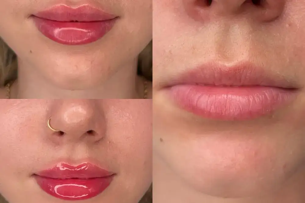 Powiększanie ust: Jak szybko zredukować opuchliznę?