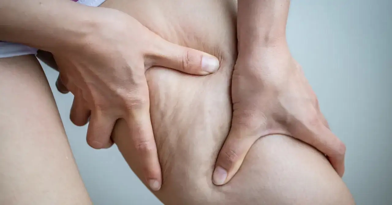 Jak pozbyć się cellulitu z ud? Domowe sposoby i zabiegi