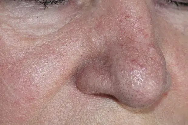 Jak wygląda zapchana cera? Objawy i skuteczne sposoby leczenia