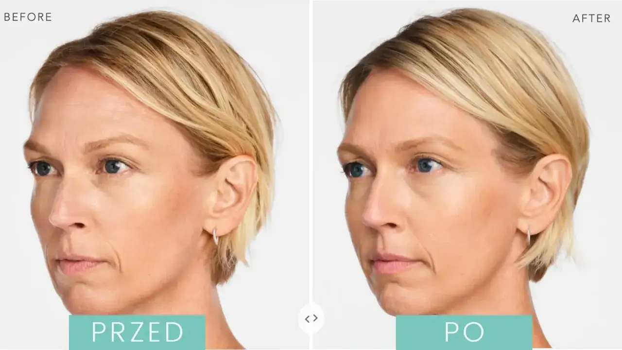 Radiesse czy kwas hialuronowy - który wypełniacz jest lepszy dla Ciebie?