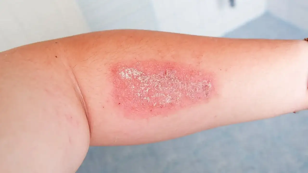 Oparzenie na ramieniu, zaczerwienione i łuszczące się. Czy mssa jest groźny? To pytanie budzi niepokój, gdy widzimy takie zmiany skórne.