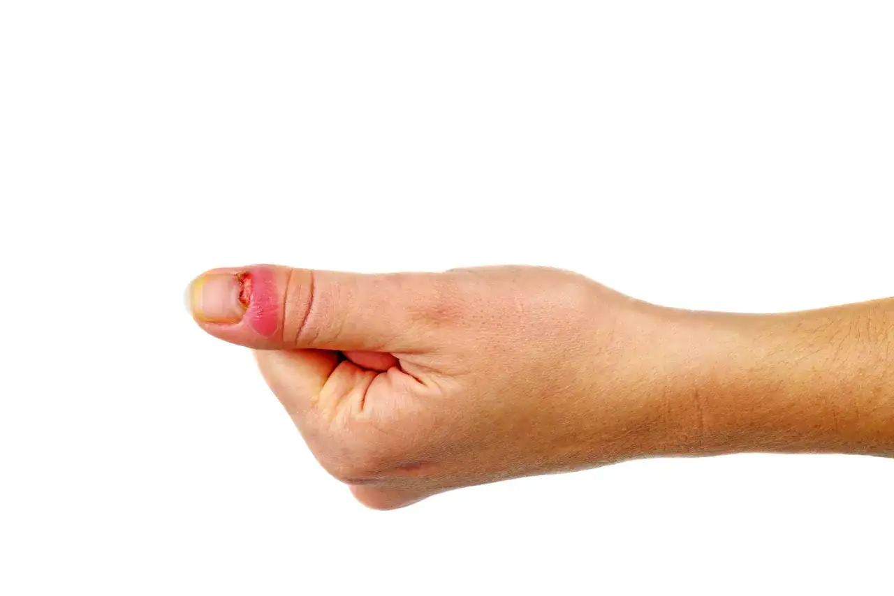 Przytrzaśnięty paznokieć: Szybka pomoc, leczenie i kiedy do lekarza?