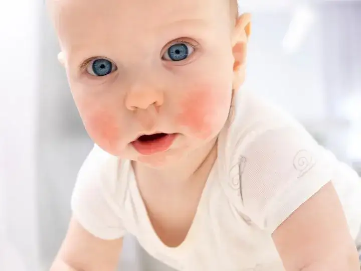 Uczulenia pokarmowe u dzieci: 7 objawów które niepokoją