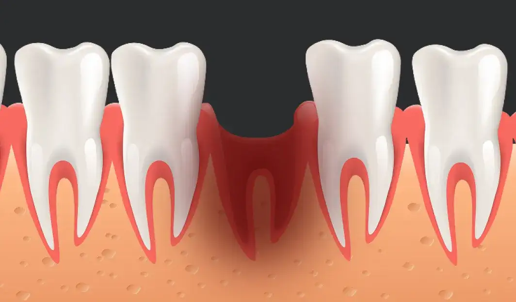 Ile goi się dziąsło? Czas gojenia, porady i jak uniknąć suchego zębodołu