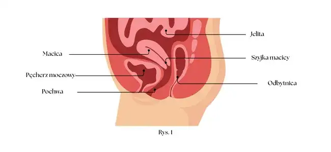 Endometrioza jelita grubego objawy: co musisz wiedzieć o bólu i problemach z wypróżnianiem