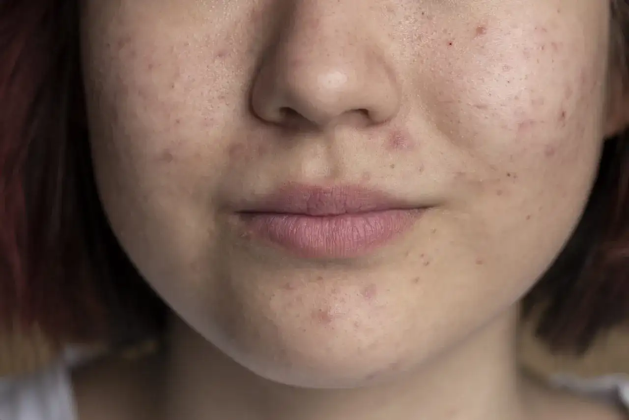 Jakie witaminy na pryszcze pomogą w walce z trądzikiem i poprawią skórę