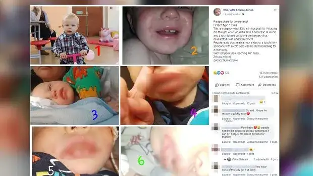 Czy dziecko z opryszczką może iść do przedszkola? Zasady i zagrożenia