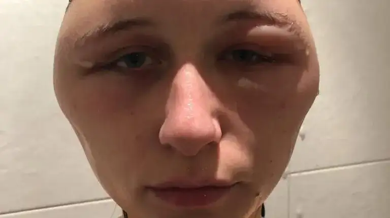 Uczulenie na ogórki kiszone objawy – jak je rozpoznać i unikać