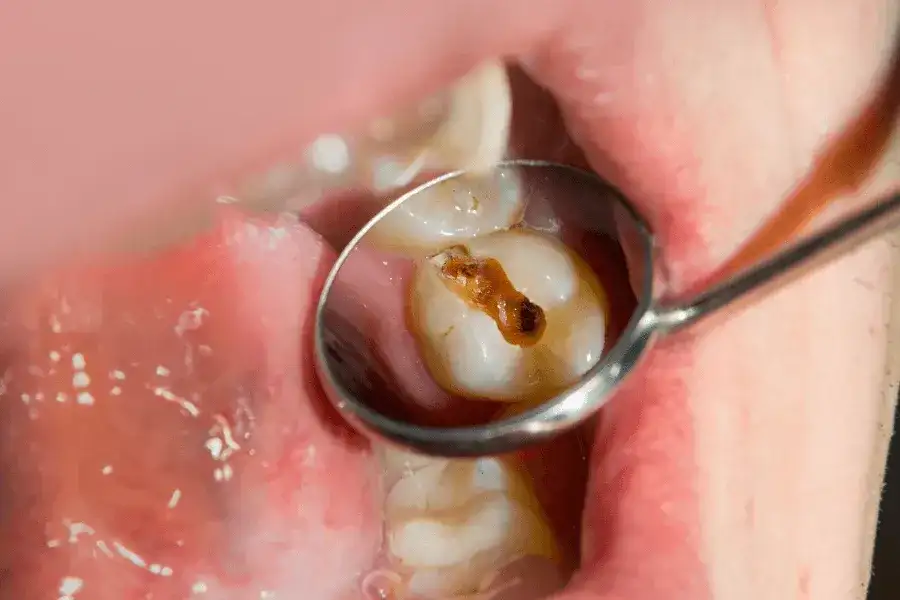 Jak dentysta sprawdza który ząb boli i co możesz zrobić, aby ulżyć bólowi