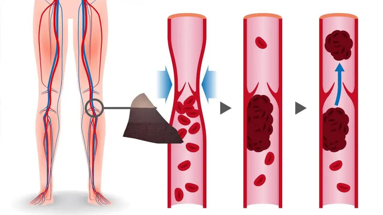 Zaburzenia krzepnięcia krwi objawy - jak je rozpoznać i leczyć