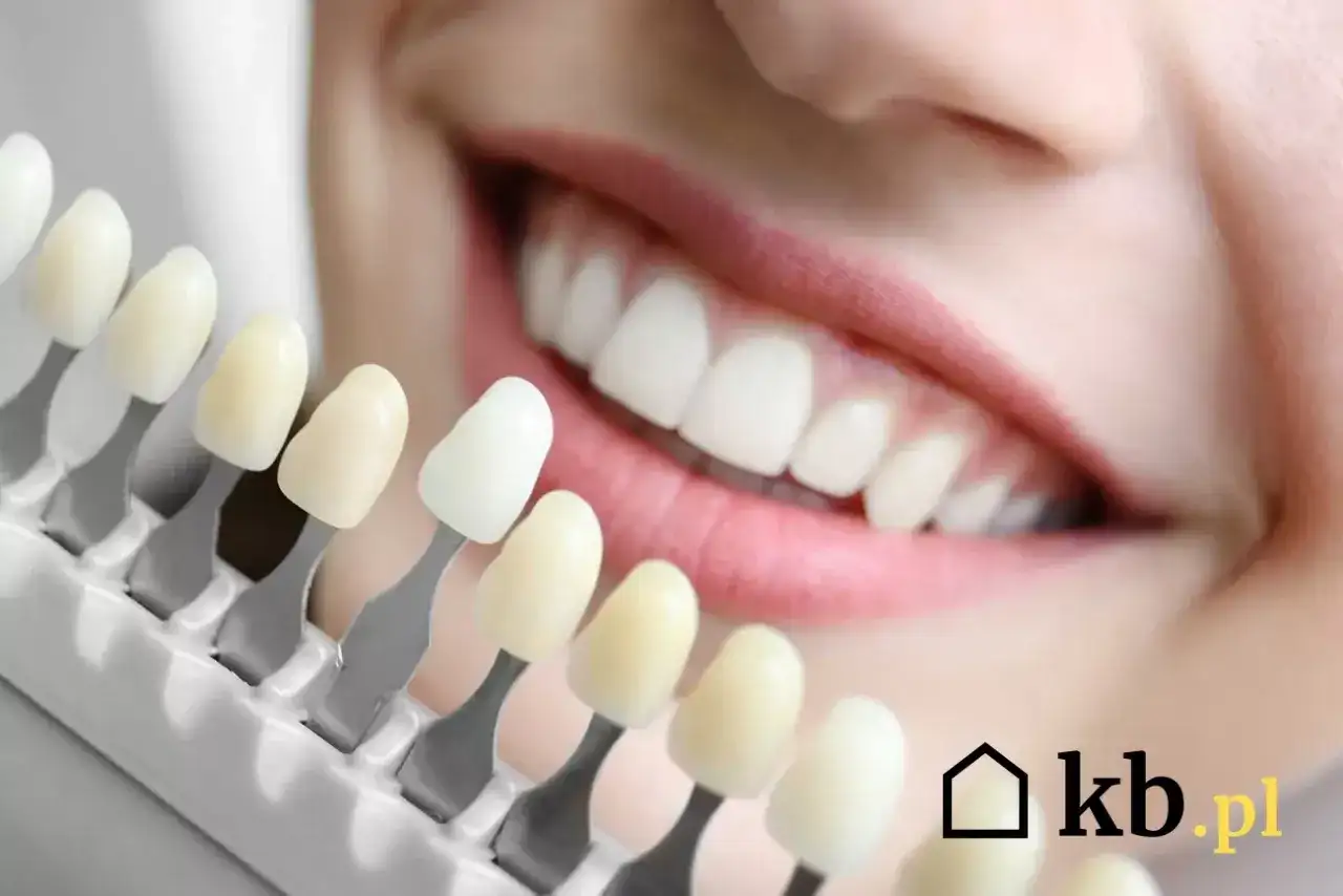 Wybielanie zębów w Polsce: Ceny, metody i sekrety trwałego uśmiechu