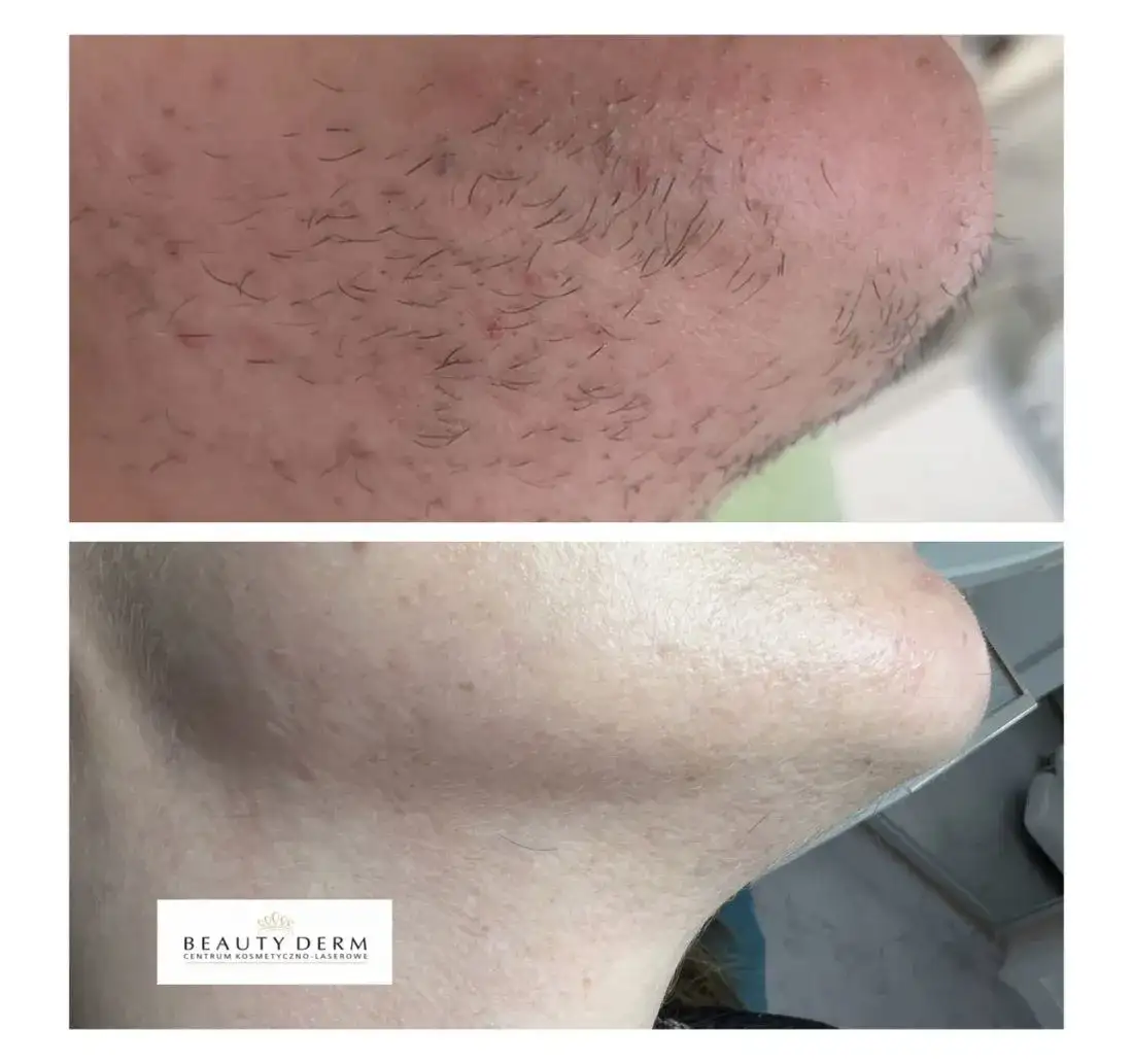 Gładka skóra bez zarostu: Laser, elektroliza czy domowe sposoby?