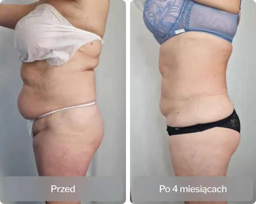 Liposukcja: Co to, metody, efekty i koszty? Pełny przewodnik!