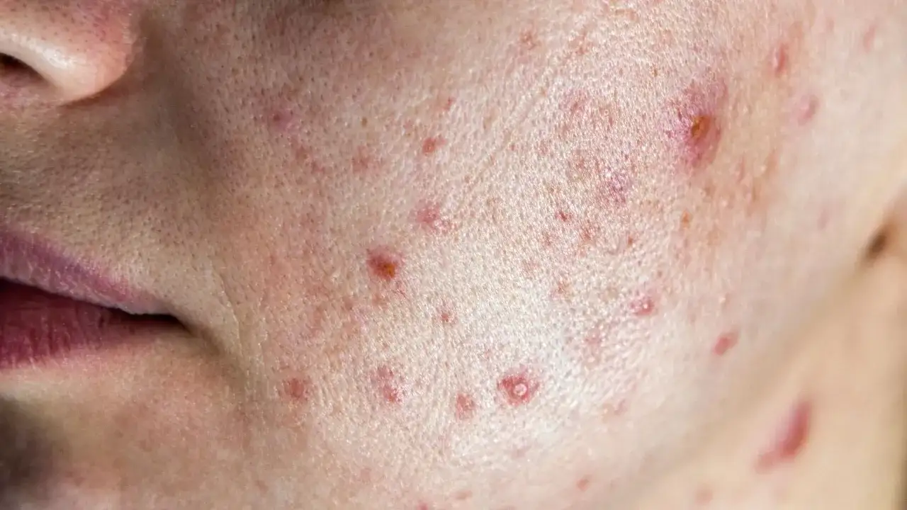 Zbliżenie na skórę twarzy z widocznymi pryszczami i zaczerwienieniami.
