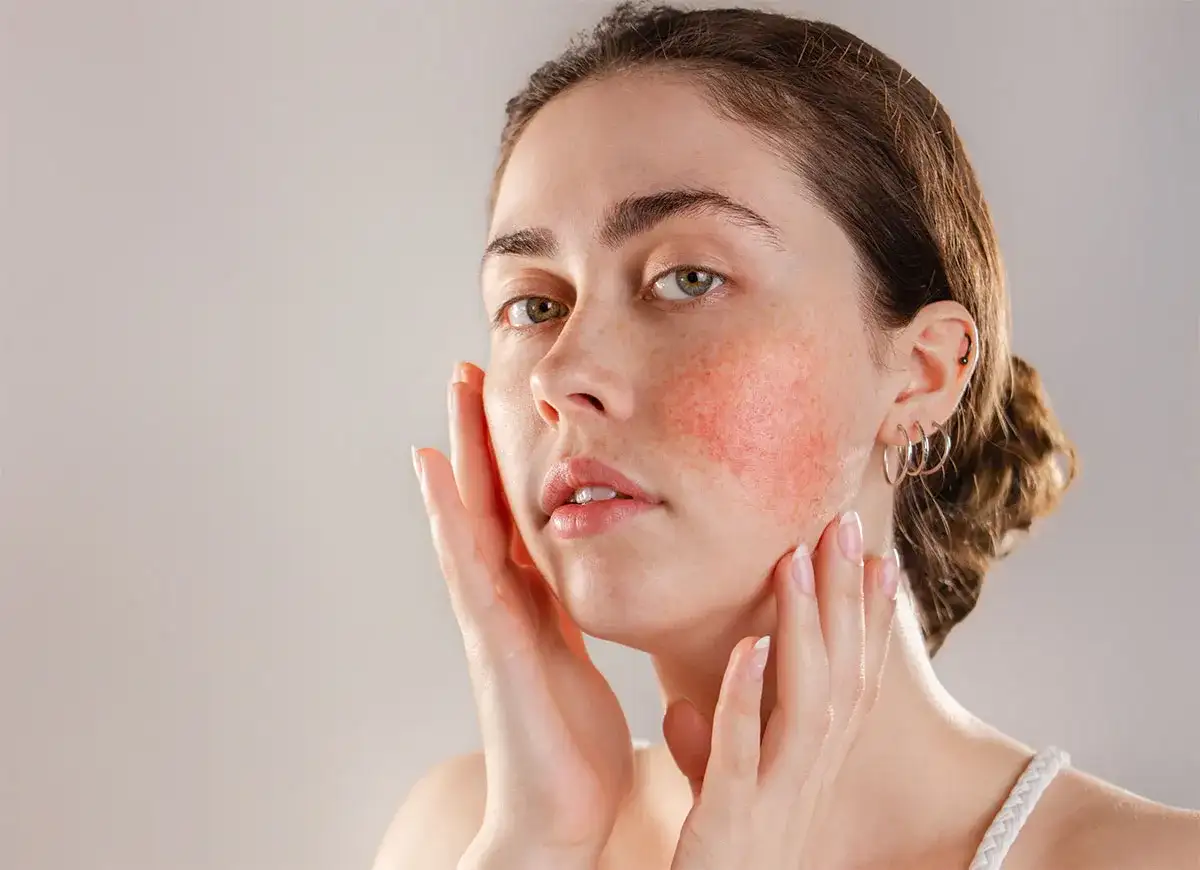 Gerötete Haut: Ursachen, Soforthilfe & die richtige Pflege | [Dein Name]