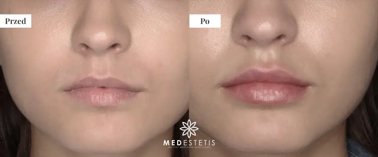 Kwas hialuronowy do ust: jak wybrać najlepszy dla naturalnego efektu?