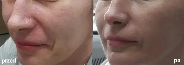 Makijaż po laserze frakcyjnym: Kiedy bezpiecznie, by nie zepsuć efektów?