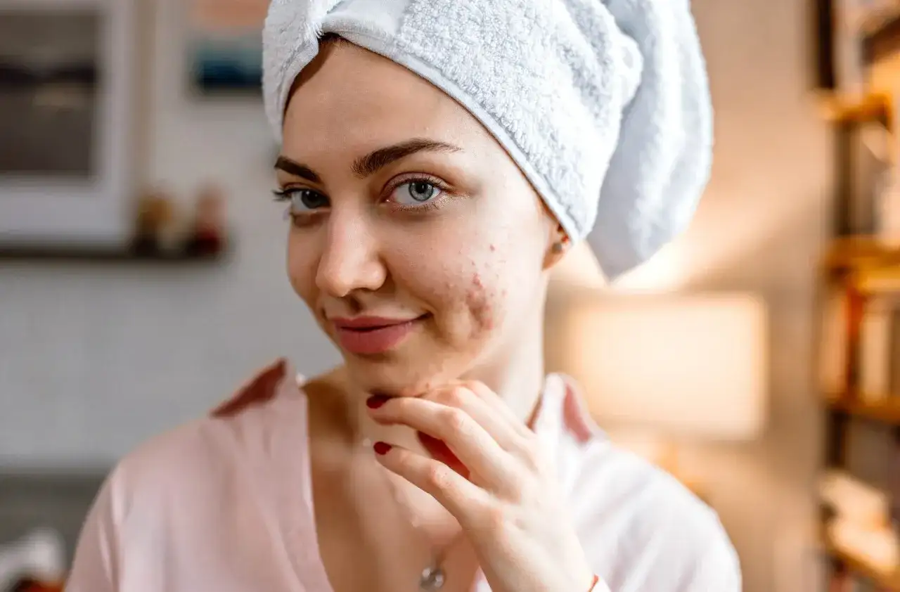 Jak pozbyć się pryszczy? Skuteczne metody i błędy w pielęgnacji