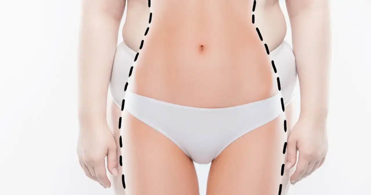 Przed i po zabiegu. Widoczna linia zaznaczająca obszar ciała, który ma zostać poddany zabiegowi. Liposukcja co to? To metoda usuwania tkanki tłuszczowej.