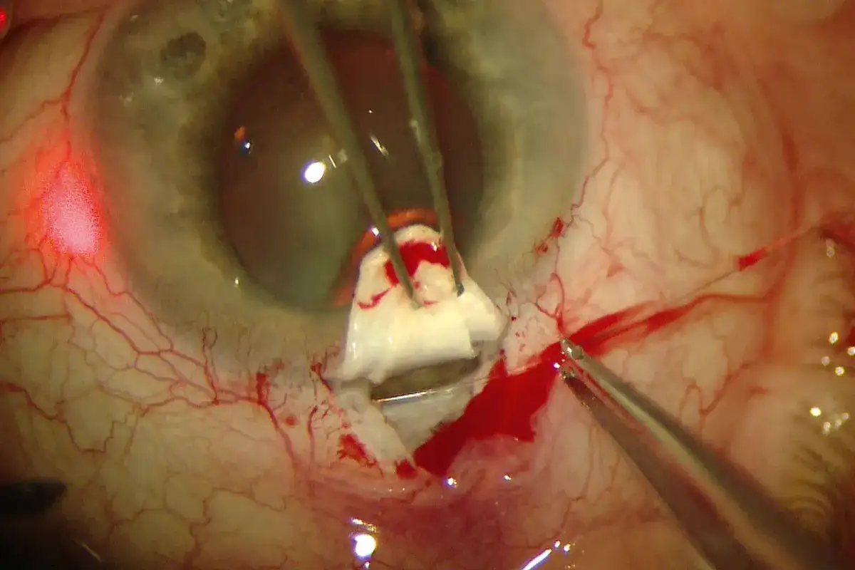 Zbliżenie na oko podczas operacji jaskry, widoczne narzędzia chirurgiczne i krew.