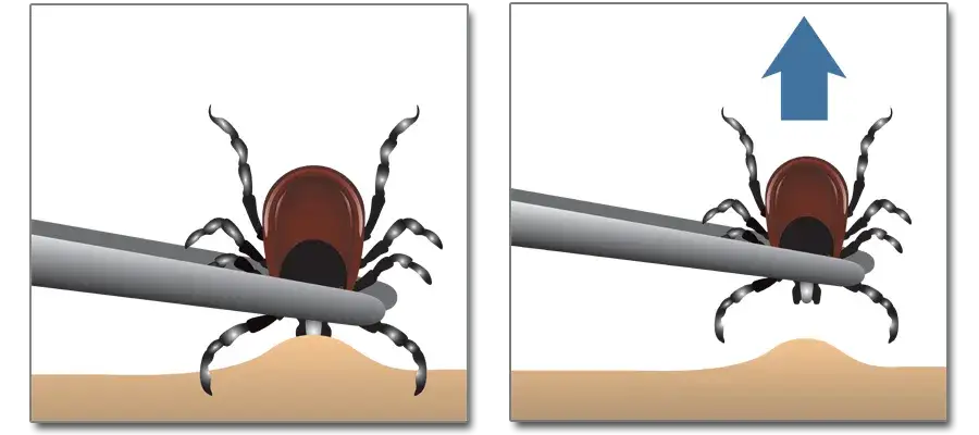 Jak wyciągnąć kleszcza dziecku bez ryzyka i komplikacji