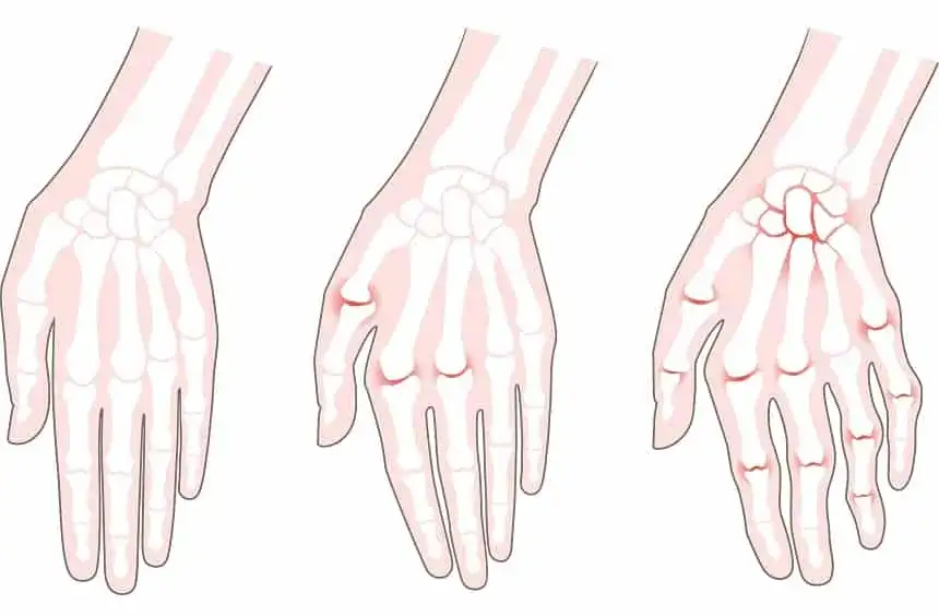 Wczesne objawy reumatoidalnego zapalenia stawów - rozpoznaj RZS