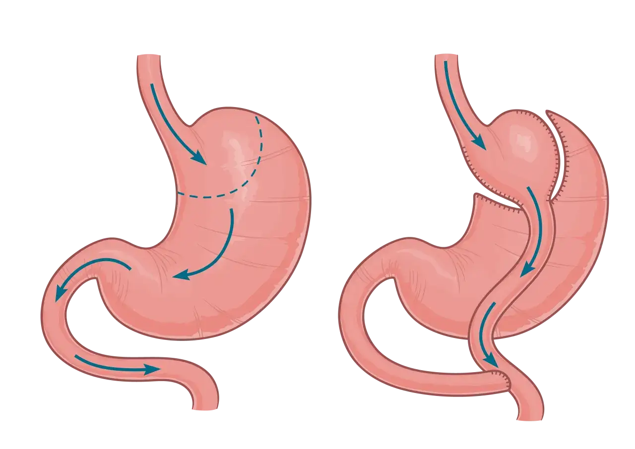 Operacja sleeve to Twoja droga do trwałej redukcji masy ciała?