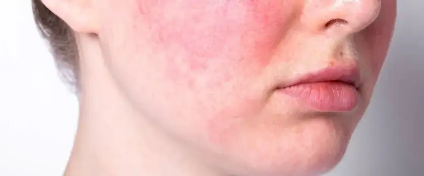 Trądzik różowaty: Skuteczne leki na receptę i bez. Poradnik.