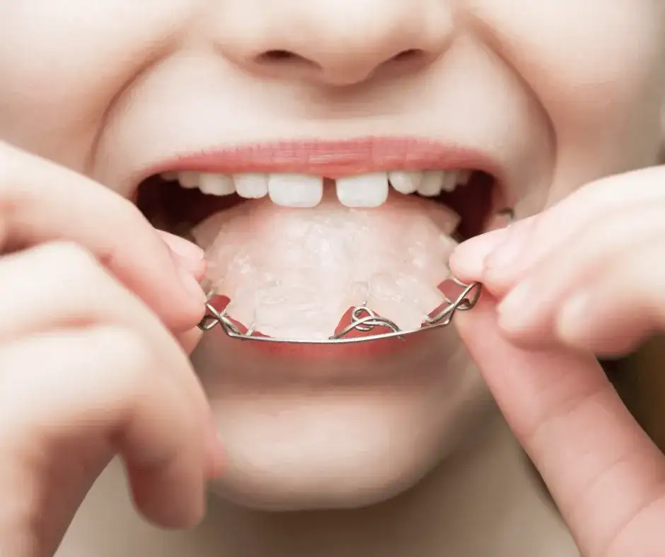 Aparat na zęby dla dziecka: Jak wygląda? Ruchomy, stały, Invisalign
