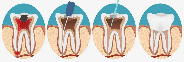 Ból po leczeniu kanałowym: Kiedy jest normalny, a kiedy alarm?