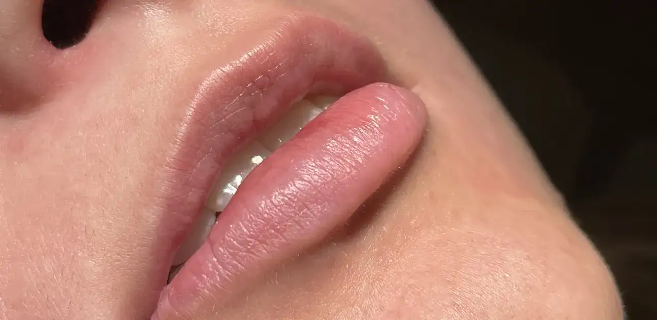 Ile kosztuje powiększanie ust? Ceny, które mogą Cię zaskoczyć