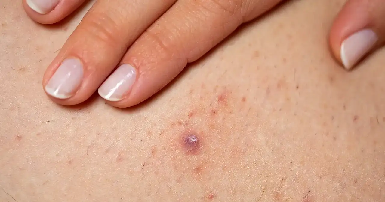 Zapalenie mieszków włosowych: Jak rozpoznać i skutecznie leczyć?