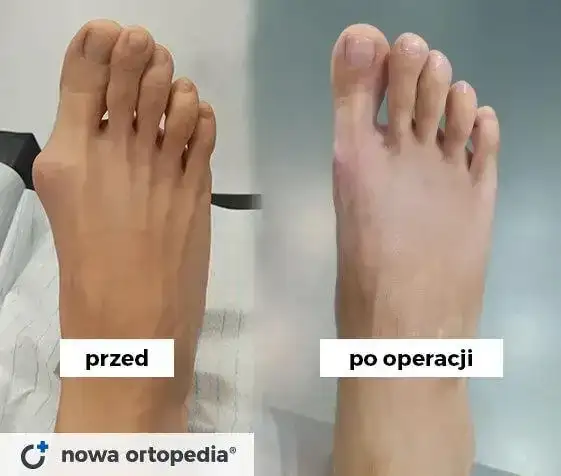 Haluksy: Gdzie najlepiej operować? Porównaj kliniki i metody.